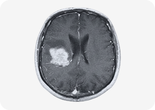 Brain MRI scan showing an abnormal brain lesion evaluated for neurological and tumor-related conditions.