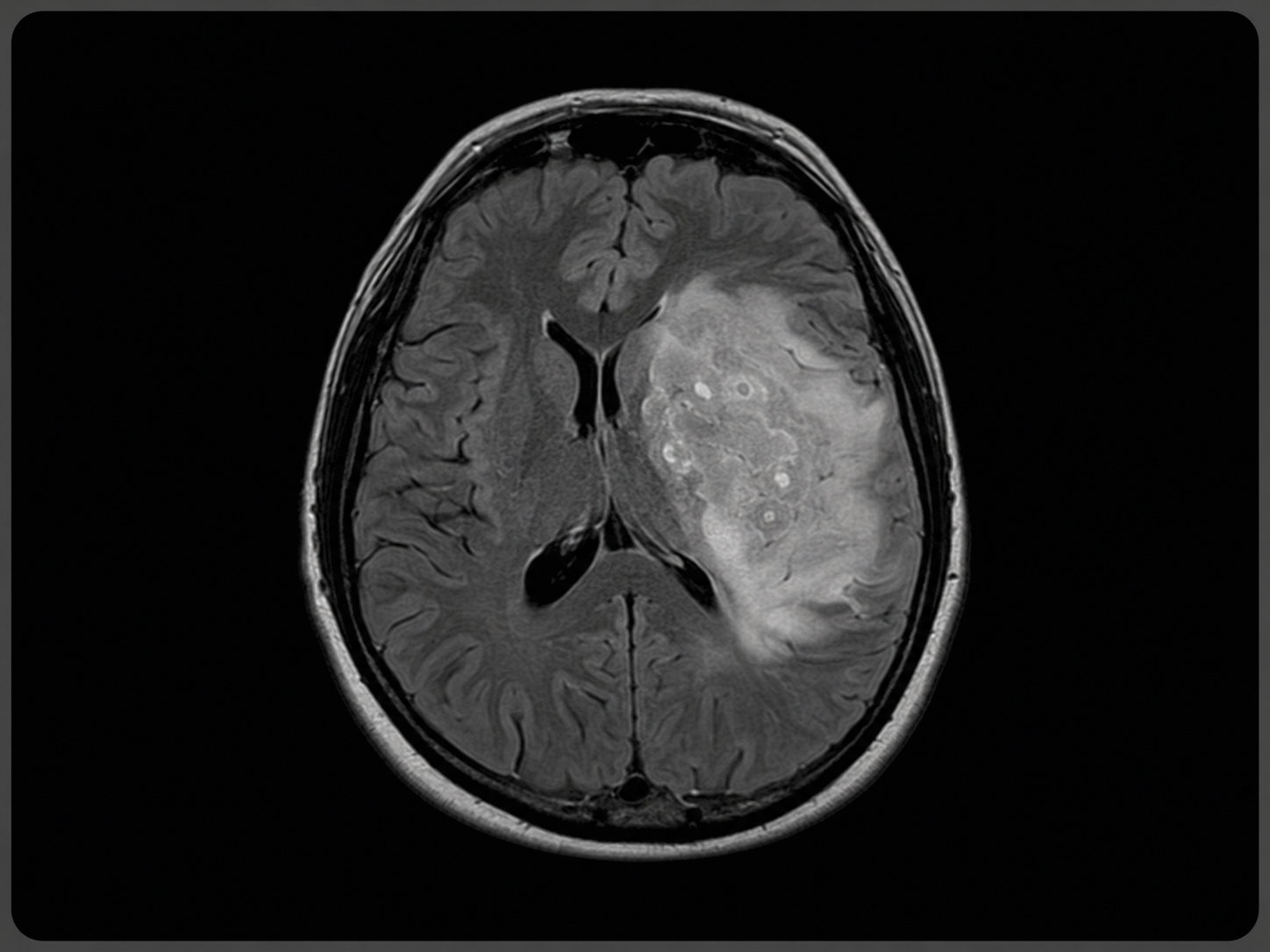 MRI-style image showing astrocytoma brain tumor evaluation and neurosurgical treatment planning.