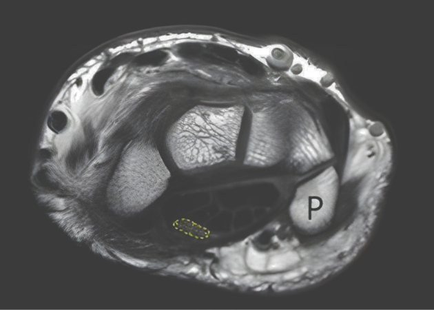 MRI scan of carpal tunnel area