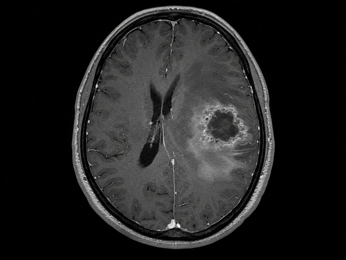 MRI-style image showing brain tumor evaluation and neurosurgical treatment planning.