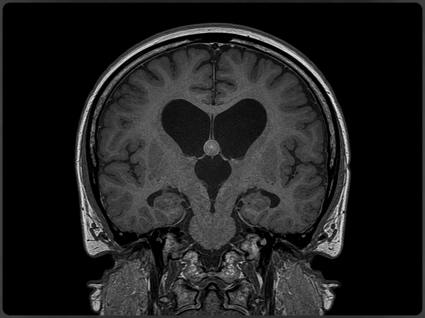 MRI-style image showing a third ventricle colloid cyst and neurosurgical treatment planning