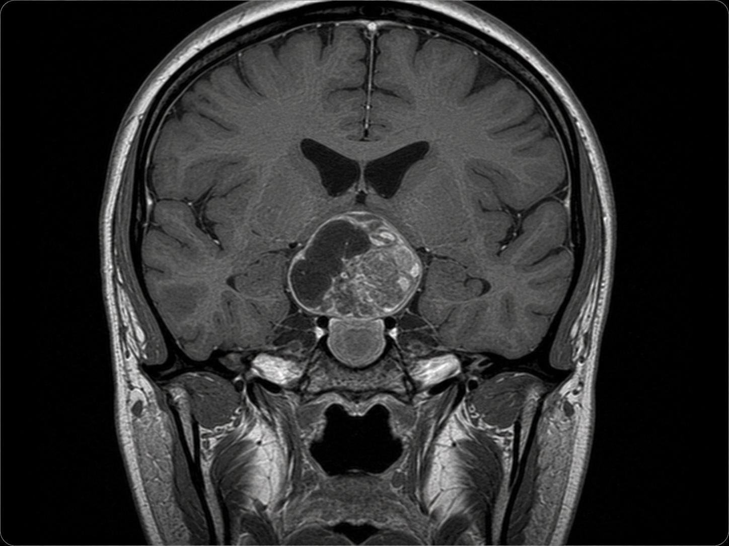 MRI-style image showing craniopharyngioma near the pituitary gland and optic chiasm