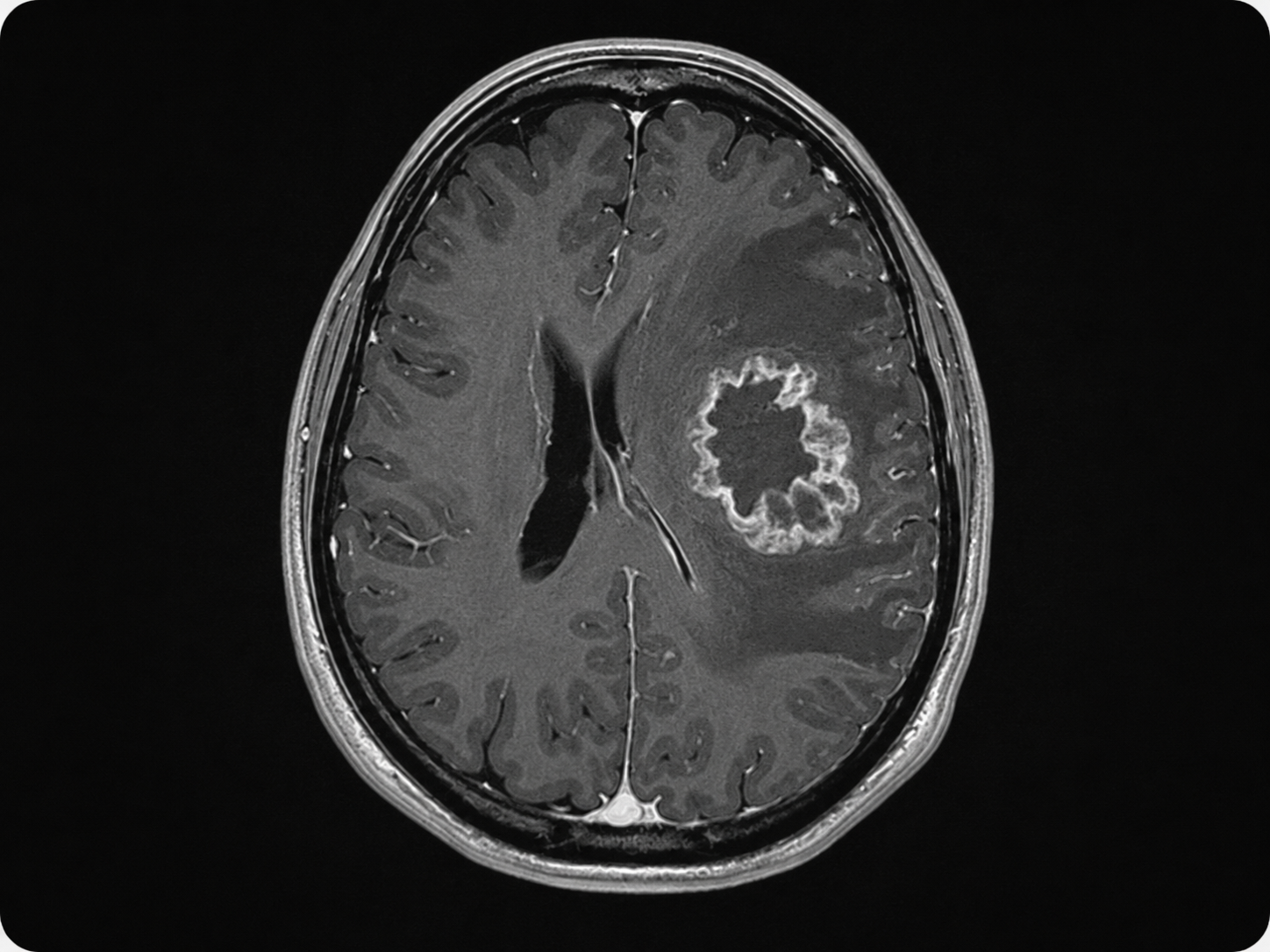 MRI-style image showing glioblastoma brain tumor evaluation and neurosurgical treatment planning