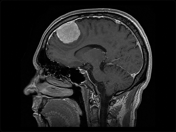 MRI-style image showing meningioma brain tumor evaluation and neurosurgical treatment planning
