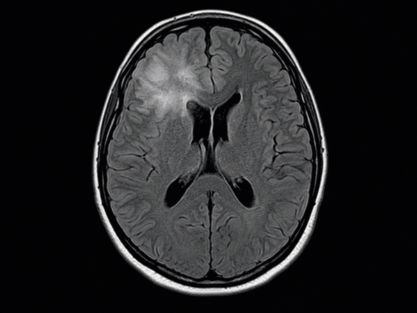 MRI-style image showing oligodendroglioma brain tumor evaluation and neurosurgical treatment planning